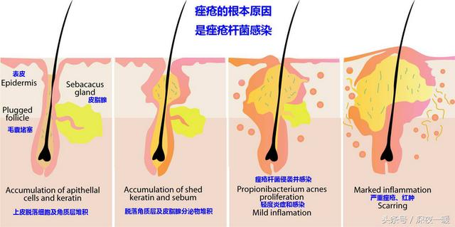 快速祛痘方法8种简单祛痘小窍门（你掌握正确的祛痘步骤了吗）(4)