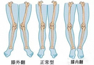 ​很多父母总觉得自己孩子腿不直？什么样的腿才是正常的呢？