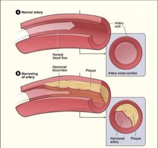​血管硬化吃什么食物可以缓解（血管硬化就回不去了，5种食物让您的血管更年轻