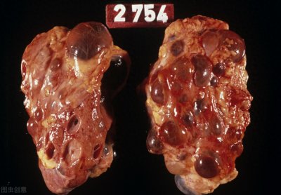​你不了解的多囊肾有多可怕？让人不忍直视