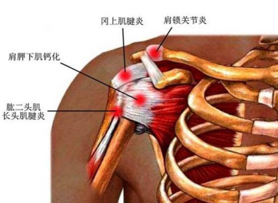 ​肩周炎三个动作自愈方法(3个动作自测肩周炎，4个拉筋动作告别肩周炎)