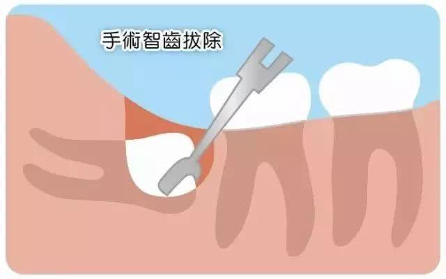 想通过拔智齿让脸变小？先来看看这个吧